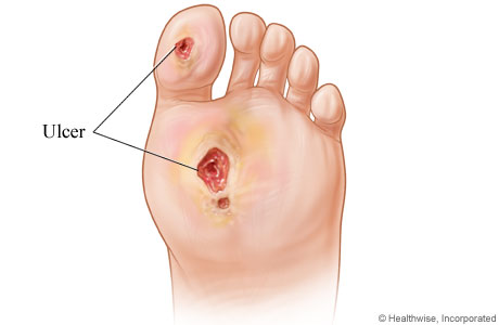 Diabetic foot ulcers.