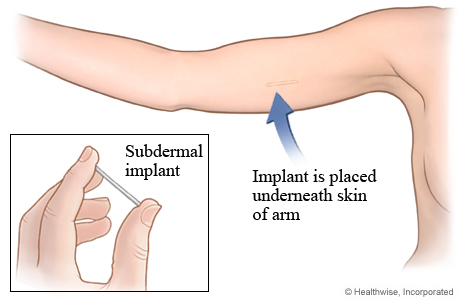 Subdermal implant for birth control.